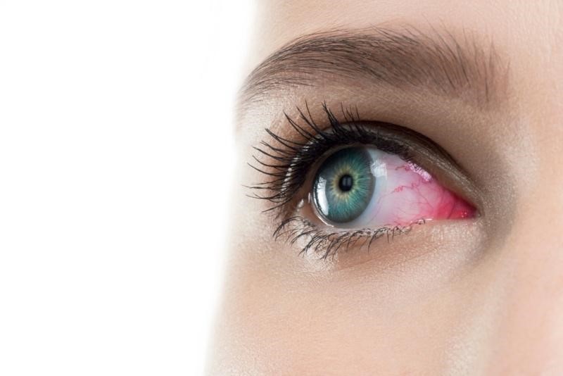 How To Treat Red Eyes After Eyelash Extensions